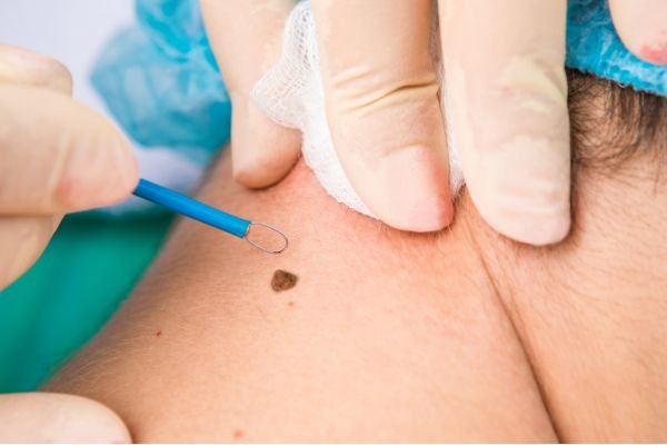 Mole Removal Treatment