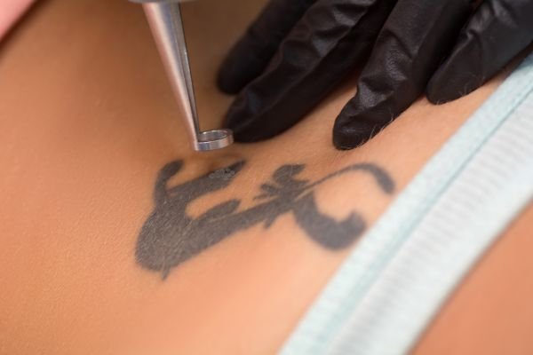 Tattoo Removal