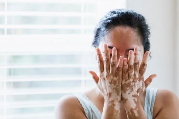 Vitiligo Surgery